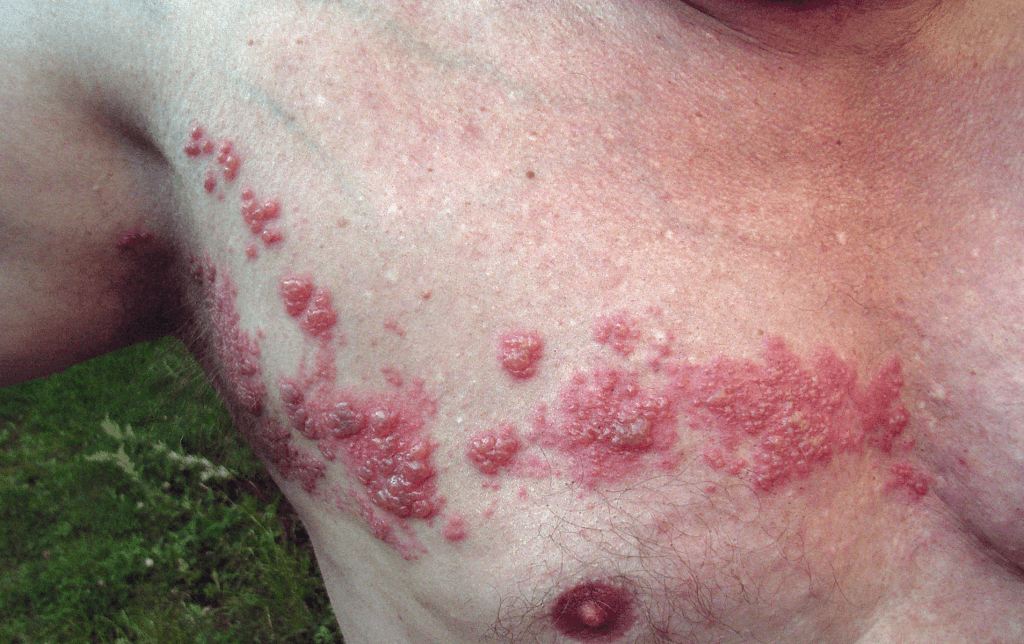 Shingles rash
