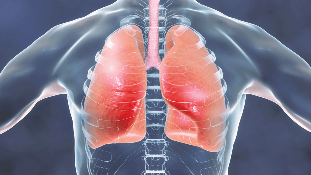 image showing infected lungs TB