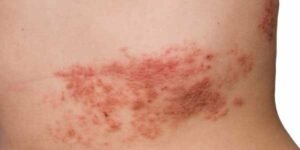Image for shingles short course product, showing tummy with shingles, herpes zoster