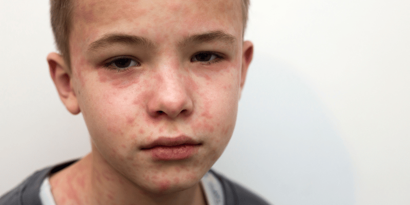 Image showing a boy with a measles rash.
Measles outbreaks