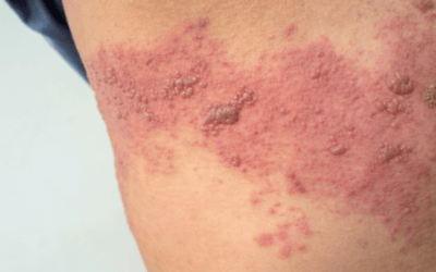 Shingles Vaccination: Where Are We Now?