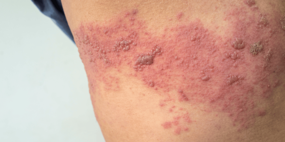 Shingles Vaccination: Where Are We Now?