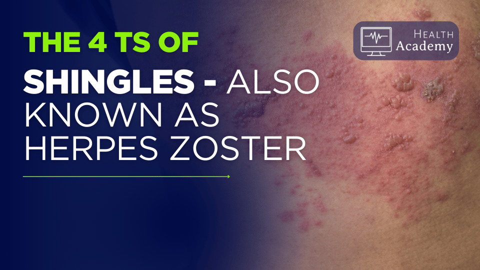 Understanding the 4T’s of Shingles