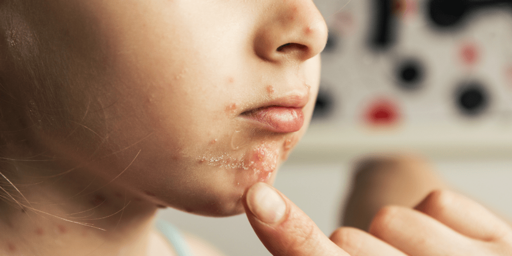 Chickenpox/Varicella Vaccine