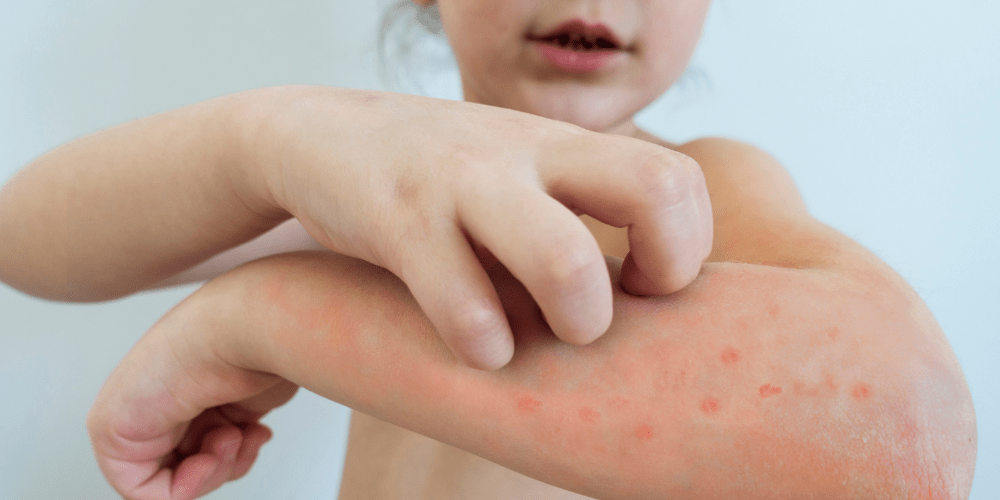 Chickenpox/Varicella Vaccine